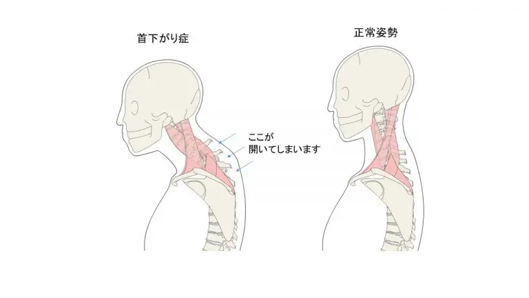 首下がり症 | 熱海所記念病院