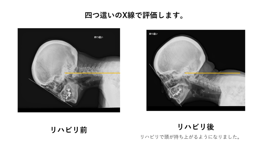 首下がり症 | 熱海所記念病院