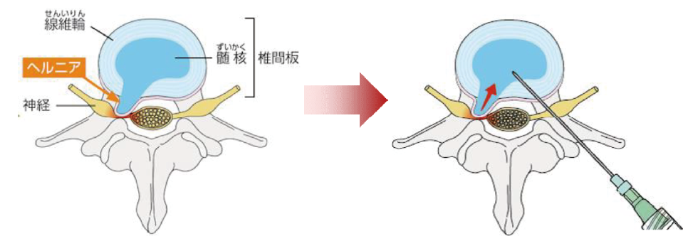 ヘルニコア【ヘルニア治療】 | 熱海所記念病院